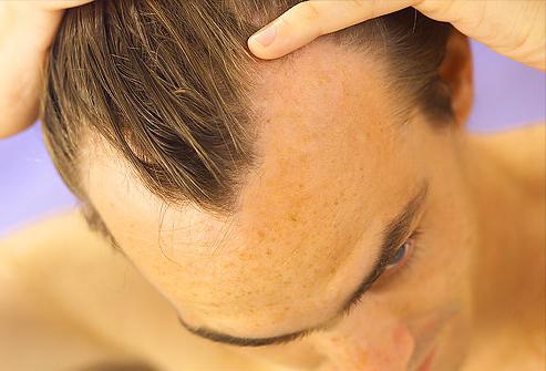 Kas sukelia plaukų slinkimą?