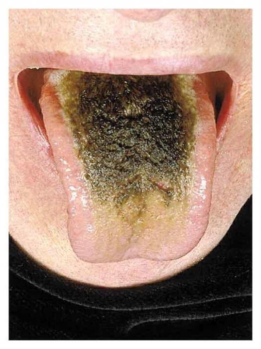 liežuvio gydymo liga