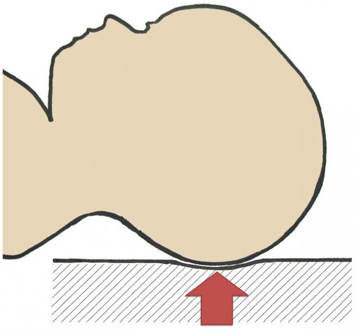 oligocėfinė naujagimio galvos forma