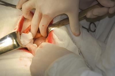 Pilvo operacija pašalinant kiaušidės ir gimdos cistą
