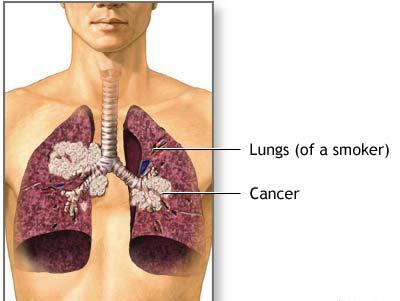 Plaučių vėžys: kiek gyvena? Ar turiu tikėti prognozes?