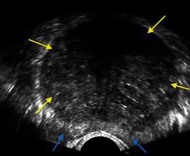 Transakcinis prostatos ultragarsas: aprašymas, paruošimas ir rekomendacijos